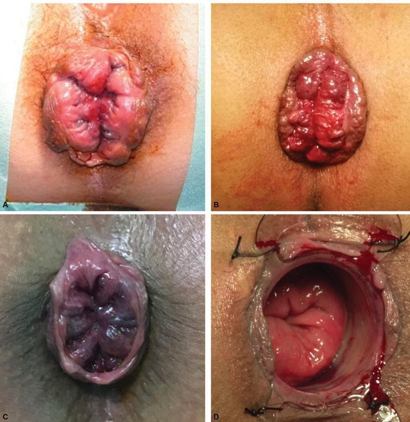 This set of clinical photographs illustrates various anatomical presentations of circumferential rectal or hemorrhoidal prolapse. Panels A and B display external views of a protruding, circumferential mass from the anal canal. The prolapsed tissue is erythematous, lobulated, and exhibits deep mucosal folds and creases, characteristic of advanced hemorrhoidal disease or full-thickness rectal prolapse. Panel C shows a similar circumferential prolapse with a darker, cyanotic, or violaceous hue, suggesting venous congestion or early strangulation. Panel D captures an intraoperative evaluation using an anal retractor (anoscopes), revealing the internal mucosal lining. This image demonstrates the bright red, vascularized tissue and the structural depth of the prolapse during surgical intervention, with visible sutures and minor bleeding at the surgical site. The collection serves to teach clinical recognition of prolapse severity and perioperative anatomical assessment in proctology and colorectal surgery.