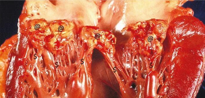 This clinical photograph displays a gross pathological view of a human heart specimen affected by infective endocarditis (IE). The primary focus is the mitral valve apparatus, which exhibits significant structural damage. Large, friable, cauliflower-like vegetations (marked with '@') are visible on the atrial surface and free margins of the valve leaflets. These vegetations appear as irregular, yellowish-tan and reddish masses composed of fibrin, platelets, and bacterial colonies. The underlying mitral valve leaflets show evidence of chronic scarring and acute destruction, including visible perforations and tissue loss. Additionally, the chordae tendineae (marked with '$') are thickened, inflamed, and scarred, which contributes to valvular incompetence. This image illustrates the severe valvular compromise—including obstruction and regurgitation—that occurs in advanced infective endocarditis, often necessitating surgical intervention.