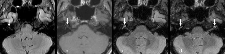 This set of axial MRI images displays the inner ear structures, specifically comparing different sequences for detecting cochlear pathology. (a) Pre-contrast 2D FLAIR shows a subtle, faintly increased signal intensity in the right cochlea (arrow). (b) Post-gadolinium 3D T1-weighted image demonstrates faint enhancement in the middle turn of the right cochlea. (c, d) Post-gadolinium 3D FLAIR images, including multiplanar reconstructions, show significantly more conspicuous bilateral enhancement. The right cochlea exhibits enhancement from the apical to the basal turn, while the left cochlea shows enhancement localized primarily to the apical turn (arrows in d). These findings illustrate the superior sensitivity of Gd-enhanced 3D FLAIR over 3D T1-weighted sequences in identifying blood-labyrinth barrier breakdown and inflammatory processes in the inner ear. The images are highly relevant for diagnosing conditions like Vogt-Koyanagi-Harada (VKH) disease, labyrinthitis, or sudden sensorineural hearing loss, highlighting the importance of sequence selection in neuro-otologic imaging.