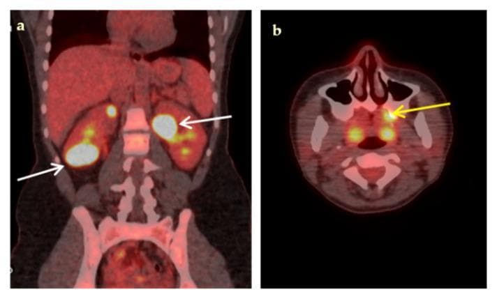 Fused 18F-FDG-PET/CT diagnostic imaging demonstrating high metabolic activity in a case of fever of unknown origin (FUO). Panel (a) is a coronal section showing bilateral, multiple, hypodense renal lesions with intense 18F-FDG uptake (high SUVmax). White arrows indicate prominent hypermetabolic foci in the lower pole of the right kidney and the upper pole of the left kidney, characteristic of renal abscesses. Panel (b) is a transaxial section of the head showing a localized area of high 18F-FDG uptake in the left maxilla (yellow arrow), indicating a primary dental infection or odontogenic source. The image illustrates the utility of PET/CT in identifying occult infectious sources, suggesting hematogenous spread from a dental focus to the kidneys. Key educational concepts include the identification of hypermetabolic inflammatory lesions and the diagnostic workup of multifocal infections using molecular imaging.