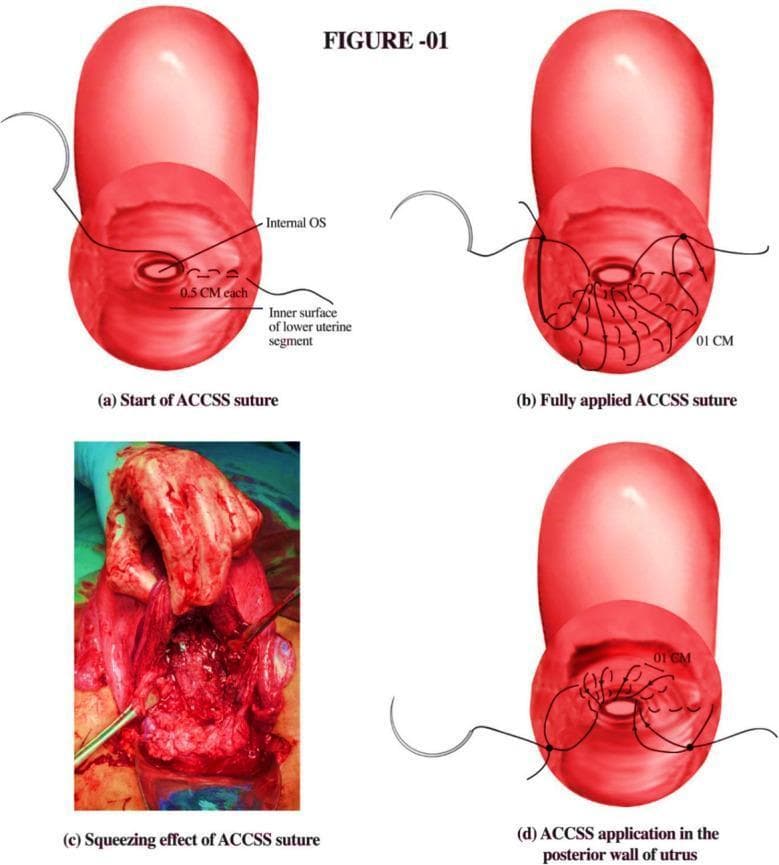 This medical illustration and clinical photograph composite describes the application of the A. Chohan Continuous Squeezing Suture (ACCSS) technique, a surgical intervention for managing hemorrhage during cesarean sections for placenta previa or accreta. The figure consists of four panels: (a) an anatomical diagram showing the initiation of the suture with 0.5 cm bites at the inner surface of the lower uterine segment near the internal os; (b) the progression to a fully applied continuous suture pattern with 1 cm intervals; (c) a clinical photograph demonstrating the intraoperative squeezing effect on the uterine tissue, showing significant tissue compression and congestion intended to achieve hemostasis; and (d) an illustration of the suture application on the posterior uterine wall. The technique utilizes a half-thickness suturing approach to compress placental site sinuses while maintaining the patency of the internal os. This educational material is designed for obstetric surgeons and trainees focusing on advanced surgical techniques for postpartum hemorrhage management.