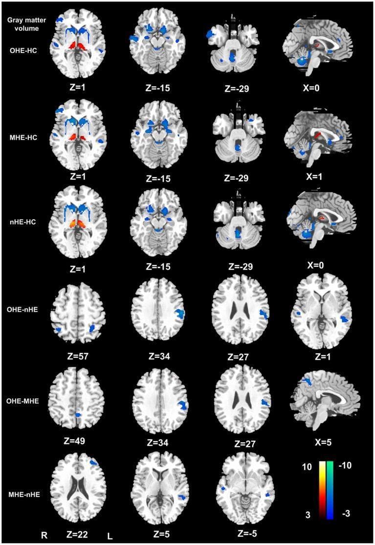 This diagnostic image displays voxel-based morphometry (VBM) results of gray matter volume changes in cirrhotic patients across different stages of hepatic encephalopathy (HE). The figure contains six rows of axial and sagittal brain MRI slices with color-coded statistical parametric maps. Rows 1-3 compare Overt HE (OHE), Minimal HE (MHE), and non-HE (nHE) patients against Healthy Controls (HC). Red/yellow clusters indicate increased gray matter volume, prominently visible in the bilateral thalami across all patient groups compared to controls. Blue clusters signify volume loss, localized primarily in the frontal, parietal, and temporal cortices, as well as the cerebellar vermis. Rows 4-6 present direct inter-group comparisons (OHE-nHE, OHE-MHE, and MHE-nHE), illustrating a progressive reduction in gray matter volume—specifically in frontal and parietal regions—as HE severity increases. A color scale is provided indicating T-values, where positive values (red/yellow) range from 3 to 10 and negative values (blue/cyan) range from -3 to -10. Slices are labeled with Z and X coordinates for anatomical localization, with L and R markers denoting laterality.