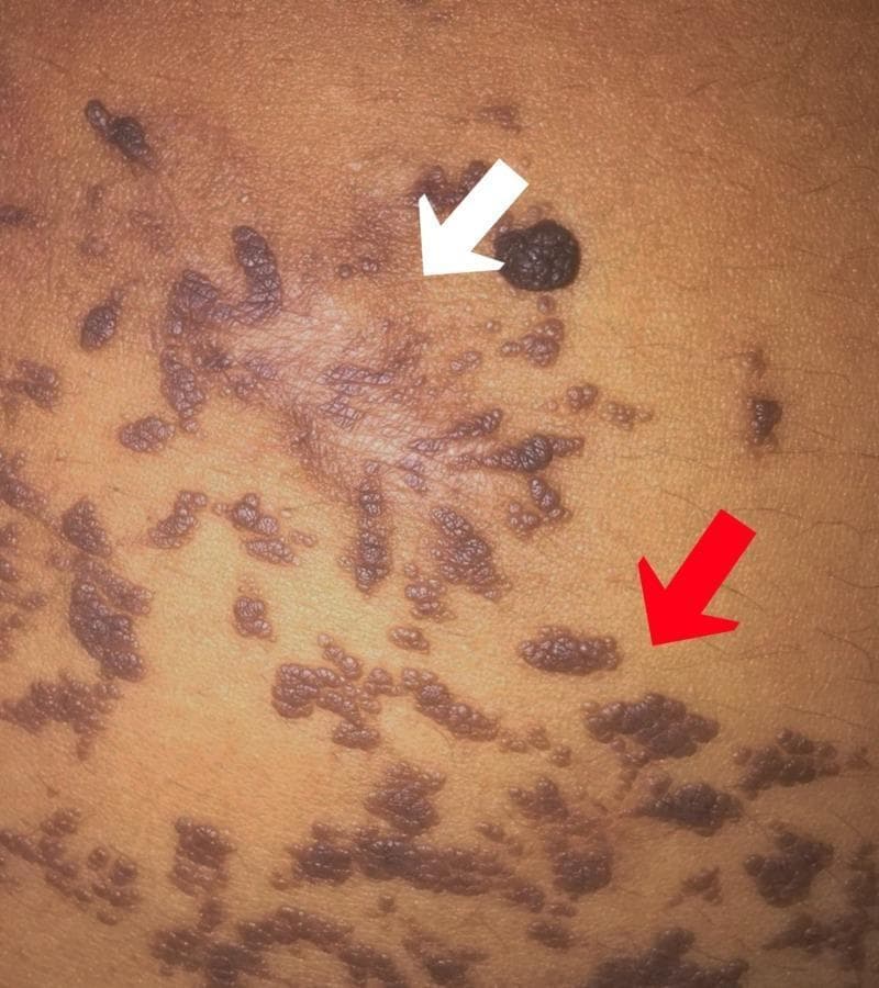 Clinical photograph of the abdominal skin in a patient with an epidermal verrucous nevus, illustrating a side-by-side comparison of untreated lesions and post-treatment sequelae. The untreated lesions (marked by a red arrow) consist of multiple, grouped, hyperpigmented dark-brown to black plaques with a distinct verrucous or 'wart-like' texture. They are irregularly shaped and distributed across the skin surface. The area marked by a white arrow demonstrates the results of previous electrofulguration and CO2 laser treatment, characterized by a flattened, hypopigmented to slightly erythematous scar with an altered skin texture and fine wrinkling. Within the treated field, a single raised, dark verrucous nodule remains. This image is used in dermatology to demonstrate the typical morphology of verrucous nevi and the potentially unaesthetic scarring associated with invasive therapeutic modalities like laser or electrofulguration on extensive lesions.