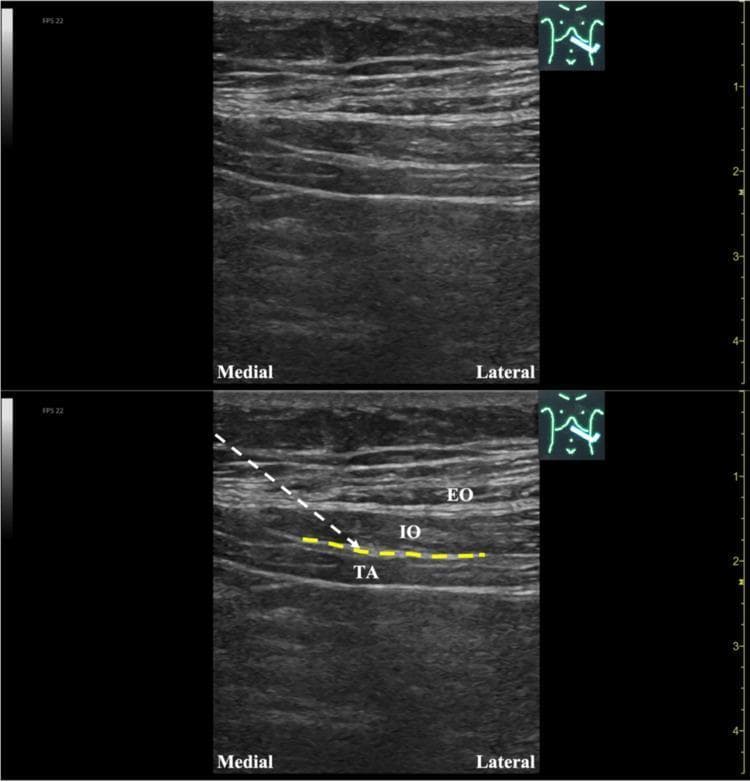 This diagnostic ultrasound image illustrates the musculoskeletal anatomy of the lateral abdominal wall, specifically for a Transversus Abdominis Plane (TAP) block or hydrodissection procedure. The image is presented in two panels: an unlabeled original view (top) and an annotated version (bottom). Three distinct muscle layers are visible with varying echogenicity: the superficial External Oblique (EO), the middle Internal Oblique (IO), and the deep Transversus Abdominis (TA). A dashed yellow line highlights the fascial plane—the TAP—situated between the IO and TA muscles. An overlaying white dashed line indicates a needle trajectory following an in-plane approach from a medial-to-lateral direction toward the target fascial space. Anatomical orientation markers 'Medial' and 'Lateral' are provided, and a depth scale in centimeters is visible on the right margin. This visual serves as an educational guide for ultrasound-guided regional anesthesia and pain management, demonstrating the precise localization of the ventral rami of spinal nerves for therapeutic intervention.