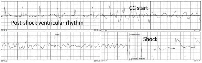 This diagnostic image displays a continuous electrocardiogram (ECG) rhythm strip illustrating a clinical scenario of Ventricular Fibrillation (VF) recurrence during cardiopulmonary resuscitation (CPR). The trace is divided into four chronological segments. In the final segment labeled 'Shock', a high-voltage deflection represents defibrillation, followed by a brief period of electrical silence and subsequent emergence of an irregular, low-amplitude 'Post-shock ventricular rhythm'. The top panel shows the initiation of chest compressions ('CC start'), characterized by regular, high-amplitude artifacts superimposed on the underlying rhythm. The middle panels demonstrate the transition from a slow, organized rhythm back into the disorganized, undulating waveforms of recurrent ventricular fibrillation. This ECG sequence serves as an educational tool for understanding rhythm morphology during advanced cardiac life support (ACLS), the visual presentation of CPR compression artifacts, and the phenomenon of post-defibrillation rhythm degeneration.