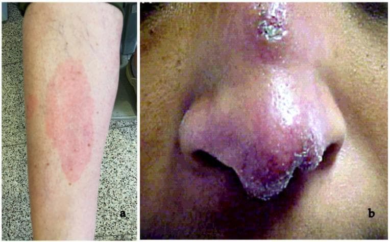 This composite clinical photograph displays two distinct dermatologic manifestations of systemic sarcoidosis. Panel (a) illustrates erythema nodosum, an acute inflammatory condition characterized by a large, ill-defined, erythematous patch on the pretibial region of the lower leg. The lesion appears as a warm, tender-looking plaque, which is a common early non-specific sign of sarcoidosis, often associated with Löfgren syndrome. Panel (b) shows lupus pernio, a pathognomonic chronic cutaneous finding. It presents as a violaceous (reddish-purple), indurated, and disfiguring plaque affecting the central face, specifically the bridge, tip, and alae of the nose. The texture is nodular with visible scaling and crusting along the nasal borders. These images contrast the transient, reactive nature of erythema nodosum against the chronic, granulomatous infiltration seen in lupus pernio, providing key diagnostic markers for the clinical evaluation of sarcoidosis in dermatology and internal medicine.