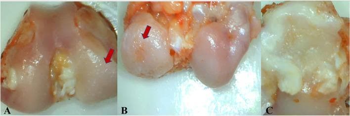 This set of gross pathological macrographs (labeled A, B, and C) illustrates severe osteoarthritic changes in a knee joint model. Image A and B focus on the femoral condyles, where red arrows highlight prominent eburnation, surface irregularities, and pitting in the load-bearing regions. Image B specifically demonstrates a localized full-thickness articular cartilage ulcer on the weight-bearing surface of the medial femoral condyle. Image C shows the medial tibial plateau, characterized by significant degenerative changes including peripheral whitish osteophyte formation and marginal erosions. These visual markers—cartilage loss, subchondral bone exposure (eburnation), and osteophytosis—are hallmark macroscopic features used to grade the severity of osteoarthritis and evaluate the impact of surgical interventions like meniscectomy on joint health. The images provide clinical context for orthopedic pathology and rheumatology education, emphasizing the progressive degradation of articular surfaces in chronic degenerative joint disease.