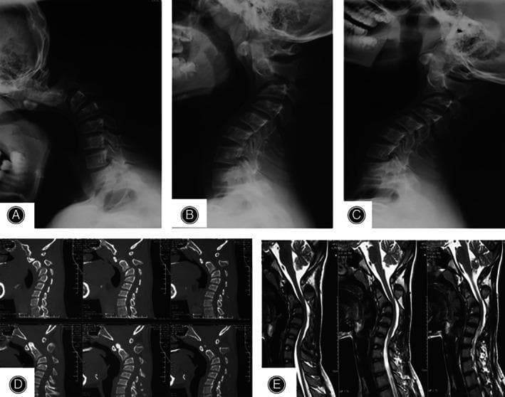 Multimodal imaging of the cervical spine demonstrating severe cervical kyphotic deformity. Panels A, B, and C show lateral x-ray radiography in hyperflexion, neutral, and hyperextension positions, respectively. These views reveal a fixed or progressive kyphosis with a Cobb angle exceeding 70 degrees in the neutral position, with minimal correction on extension. Panel D presents a sagittal CT scan highlighting the bony anatomy; the vertebral bodies maintain relatively normal rectangular morphology and bone density without significant osteophyte formation or syndesmophytes, suggesting a non-degenerative etiology like Ankylosing Spondylitis. Panel E consists of sagittal T2-weighted MRI slices, which show the severe sagittal malalignment but indicate no evidence of significant spinal cord compression or myelomalacia at the apex of the deformity. This imaging series is characteristic for evaluating Ankylosing Spondylitis-induced cervical kyphosis (AICK) and planning surgical correction such as anterior cervical discectomy and fusion (ACDF) or osteotomy.