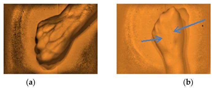 Two diagnostic images (a and b) demonstrating the efficacy of a near-infrared (NIR) vein finder on the dorsal hand. The images utilize a 960 nm wavelength to capitalize on the high absorption of deoxyhemoglobin, creating contrast between darker venous structures and lighter surrounding tissue. Image (a) represents a 'highly visible' result, showing a clear, branching network of superficial veins with sharp definition and high contrast across the metacarpal region and wrist. Image (b) shows a 'visible' result where the venous structures, indicated by blue arrows, are present but appear with lower contrast and less distinct boundaries, potentially due to variations in subcutaneous tissue thickness, vein depth, or skin pigmentation. This comparison illustrates the clinical application of transillumination and reflected light principles in facilitating venipuncture and peripheral intravenous access by mapping subcutaneous vascular patterns in real-time.