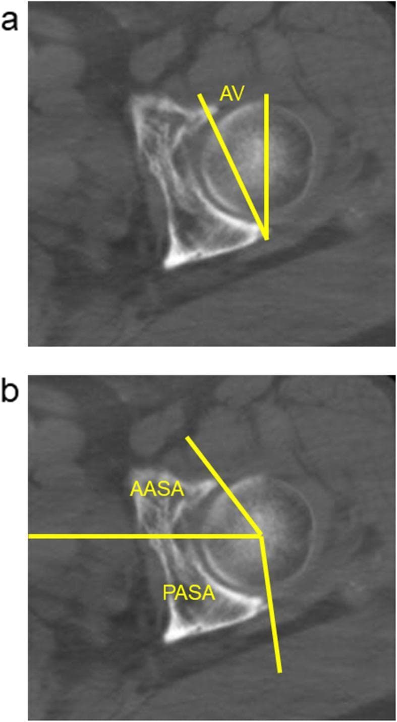 This diagnostic image consists of two axial CT slices (labeled a and b) of the human hip joint at the level of the femoral head center, demonstrating standardized methods for assessing 3D acetabular morphology. Image 'a' illustrates the measurement of acetabular anteversion (AV) using two intersecting yellow lines at the acetabular margins. Image 'b' demonstrates the measurement of the anterior acetabular sector angle (AASA) and the posterior acetabular sector angle (PASA). These angles are defined by a horizontal reference line passing through the center of the femoral head and lines extending to the anterior and posterior acetabular rims, respectively. These measurements are clinically significant in orthopedics for evaluating bony coverage of the femoral head, diagnosing acetabular dysplasia, and planning or evaluating surgical interventions such as rotational acetabular osteotomy (RAO). The images provide a high-contrast view of cortical bone against surrounding soft tissue, essential for precise morphometric analysis of the acetabulum.
