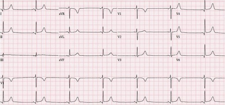 A standard 12-lead electrocardiogram (ECG) printed on red-grid thermal paper, illustrating marked sinus bradycardia. The tracing is organized into a four-column format: the first column displays leads I, II, and III; the second contains augmented limb leads (aVR, aVL, aVF); and the final two columns present precordial leads V1 through V6. Below the standard leads, continuous rhythm strips (specifically V1 and a rhythm strip likely corresponding to lead II) facilitate rhythm assessment. The heart rate is significantly reduced, calculated at approximately 42 beats per minute based on the wide R-R intervals. Despite the slow rate, the rhythm remains regular with a 1:1 P-wave to QRS complex ratio. Key intervals including the PR interval, QRS duration, and QTc appear within normal physiologic limits. This diagnostic image serves as a clinical example of sinus node-driven bradycardia without evidence of advanced heart block or acute ST-segment changes.