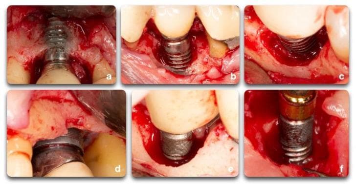 This composite of six intraoperative clinical photographs (a-f) illustrates various morphological classifications of peri-implant bone defects encountered during surgical treatment of peri-implantitis. (a) Displays a facial dehiscence where the buccal bone plate is lost, exposing the implant threads. (b, c) Show a combination of facial dehiscence and a semi-circumferential defect, indicating bone loss around a portion of the implant perimeter. (d) Illustrates a circumferential defect characterized by bone loss surrounding the entire implant diameter, combined with supra-crestal bone resorption where the bone level has receded below the original implant crest. (e) Features a deep circumferential defect with multiple remaining bony walls. (f) Demonstrates a semi-circumferential defect associated with supra-crestal bone loss. The images highlight key diagnostic features including altered tissue contours, varying degrees of implant thread exposure, and the presence of inflammatory granulation tissue. These visual examples categorize defects essential for determining the feasibility of regenerative procedures versus resective surgery in periodontology and oral implantology.