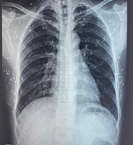 This diagnostic image is an anteroposterior (AP) chest X-ray demonstrating a classic presentation of disseminated cysticercosis. The radiograph reveals numerous small, ovoid, radiopaque calcifications—often described as 'rice-grain' calcifications—distributed throughout the soft tissues of the thoracic wall, axillae, and neck. These lesions represent the calcified larval cysts (cysticerci) of the Taenia solium tapeworm within the skeletal muscles. The lung parenchyma appears clear, without evidence of active infiltrates, consolidation, or pleural effusion. The cardiac silhouette is within normal limits for size and shape, and the visualized bony structures of the rib cage and clavicles appear intact. This radiological finding is pathognomonic for the chronic, calcified stage of muscular cysticercosis and is a key clinical indicator for investigating further neurological involvement, such as neurocysticercosis, in patients presenting with seizures.