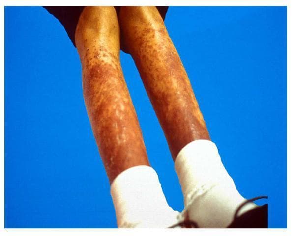 This clinical photograph shows the bilateral lower extremities of a pediatric patient, exhibiting a diffuse cutaneous manifestation of childhood sarcoidosis. The skin displays extensive, erythematous to violaceous (purplish) lesions characterized by a combination of elevated nodules and scaly plaques. These lesions are distributed symmetrically along the shins and calves, ranging from small individual papules to larger, confluent nodular areas. The texture appears irregular, with visible scaling or ichthyosiform changes in several patches. In the context of sarcoidosis, these findings represent cutaneous granulomatous involvement, which occurs in approximately 24-40% of older children. The image serves as an educational example of the diverse dermatological presentations of systemic sarcoidosis, highlighting the importance of skin examination in the diagnostic workup of the disease.
