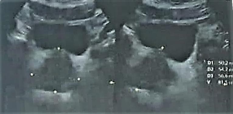This diagnostic image consists of two side-by-side grayscale ultrasound frames of the male pelvis, specifically demonstrating the prostate gland in a patient with benign prostatic hyperplasia (BPH). The prostate appears enlarged with a heterogeneous echogenicity pattern and a somewhat nodular texture, characteristic of hyperplastic transition zone growth. Caliper markers (small white dots) are positioned across the gland to measure three-dimensional parameters (D1, D2, and D3) to calculate the total prostatic volume (V), shown as numerical values on the right-hand side. The bladder, appearing as a dark, hypoechoic space, is visible superior to the prostate. The image illustrates the typical transrectal ultrasound (TRUS) appearance of BPH, where the transition zone expands and compresses the peripheral zone, often creating a 'surgical capsule' boundary. This visual is used for clinical assessment of prostate volume, which is a key factor in staging the severity of BPH and determining the necessity for medical or surgical intervention.