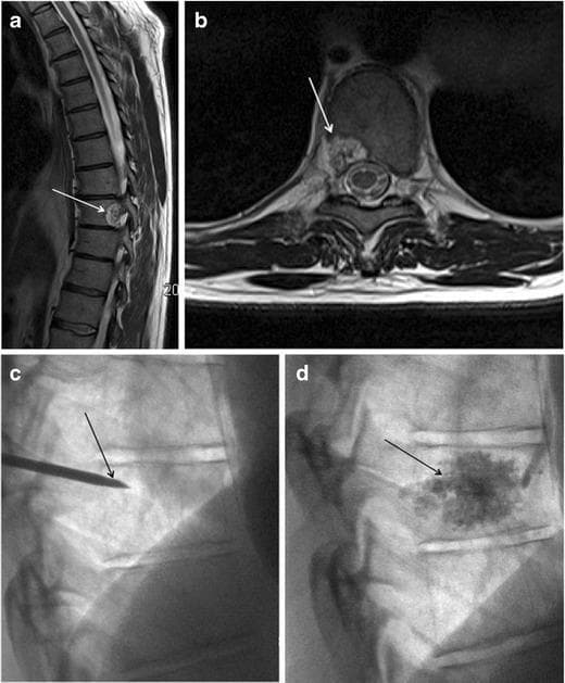 This composite figure demonstrates the diagnostic imaging and interventional management of a spinal hemangioma in the thoracic spine.