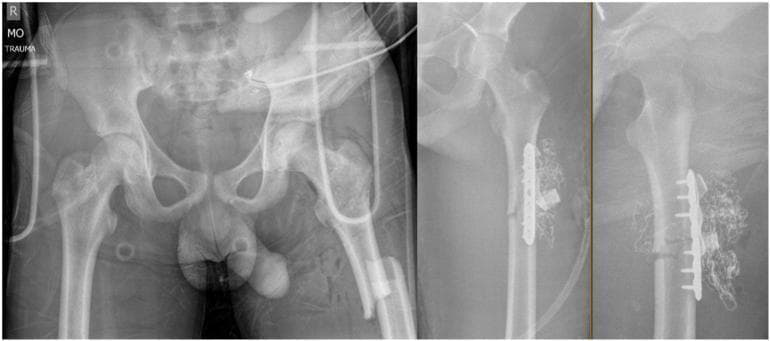 This composite diagnostic image consists of three x-ray radiographs of the pelvis and left femur in a trauma setting. The leftmost panel is an AP radiograph of the pelvis showing the bilateral hip joints, pubic symphysis, and sacroiliac regions. The middle and right panels show AP and lateral views, respectively, of the left femur. The femur radiographs reveal a subtrochanteric fracture that has undergone provisional stabilization. A radiopaque 3.5 mm locking compression plate (LCP) is affixed across the fracture site with multiple screws. Distinctive dense, coiled, radiopaque material is visible in the anterior thigh soft tissues adjacent to the plate, indicating surgical packing for damage control hemostasis. The images illustrate damage control orthopaedic management of high-energy musculoskeletal injuries, focusing on temporary internal fixation and hemorrhage control. External tubes and a pelvic binder/monitoring equipment are also visible, consistent with acute trauma management.