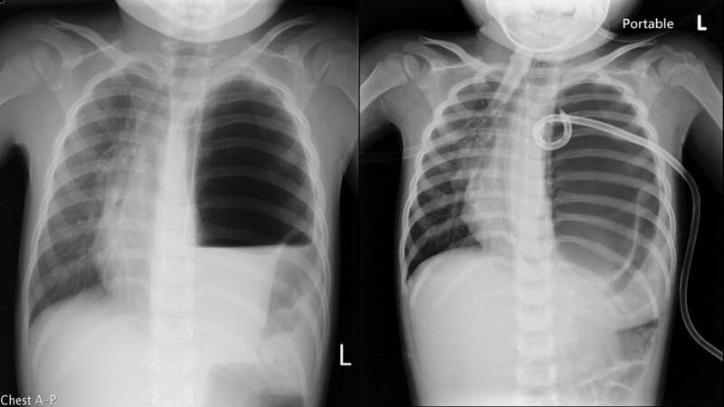 Anteroposterior (AP) chest radiographs of a pediatric patient illustrating a case of Congenital Diaphragmatic Hernia (CDH) mimicking a tension pneumothorax. The left panel shows a massive radiolucent area in the left hemithorax with a complete absence of normal lung markings and a prominent horizontal air-fluid level. A significant mediastinal shift to the right is visible, evidenced by the displacement of the heart and trachea. The right panel demonstrates the same patient after an attempted decompression with a pigtail catheter. The catheter tip is coiled within the left thoracic cavity, but the large air-filled space persists without significant lung re-expansion, a finding highly suggestive of a herniated hollow viscus (such as the stomach) rather than a simple pneumothorax. This comparison highlights the importance of distinguishing CDH from tension pneumothorax in pediatric emergencies to avoid unnecessary or harmful invasive procedures like needle decompression or tube thoracostomy.