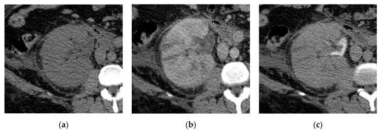 This diagnostic image set consists of three axial CT scans (a, b, and c) of the right kidney, illustrating the radiological presentation of acute pyelonephritis. (a) A non-contrast CT image shows significant renal enlargement with an irregular capsular outline. There is evidence of perinephric inflammation, including thickening of the Gerota fascia and increased density (stranding) in the perinephric fat. (b) An early post-contrast CT image reveals a striated nephrogram pattern, characterized by alternating linear streaks of high and low attenuation extending from the renal papillae to the cortex. This represents impaired or delayed parenchymal enhancement typical of acute infection. (c) A delayed post-contrast CT image demonstrates the persistence of these striated enhancement defects and further highlights the poorly functioning parenchyma. These findings collectively demonstrate the classic CT features used to diagnose acute pyelonephritis and assess for complications like interstitial edema or vasospasm within the renal collecting system.