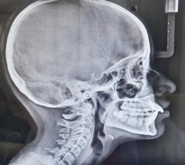 This diagnostic image is a lateral cephalogram, a standardized orthodontic X-ray providing a profile view of the human skull. The radiograph displays the cranium, facial bones, and the upper cervical spine (C1-C5). Key anatomical landmarks visible include the sella turcica, nasion, and the pterygomaxillary fissure. The dental and skeletal relationship demonstrates a Class II malocclusion, characterized by a retrognathic mandible relative to the maxilla. The maxillary incisors appear proclined, and there is a noticeable overjet. The soft tissue profile is clearly outlined, showing the nose, lips, and chin contour, which aids in assessing the patient's aesthetic harmony. The nasal bone is well-defined, and the pharyngeal airway space appears patent. This imaging modality is essential in orthodontics and maxillofacial surgery for cephalometric analysis, treatment planning, and monitoring craniofacial growth and development.
