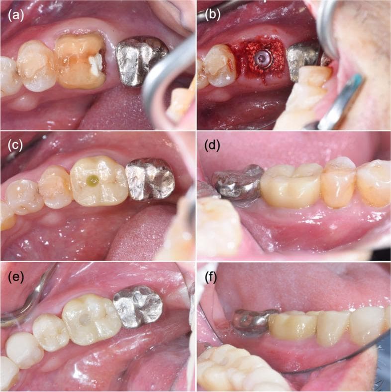 A series of six clinical intraoral photographs documenting the timeline of an immediate dental implant procedure for tooth 46 (mandibular right first molar). (a) Pre-operative occlusal view showing an unrestorable tooth with significant coronal destruction. (b) Intra-operative view of immediate implant placement following extraction, demonstrating the implant fixture positioned within the socket surrounded by xenograft bone grafting material. (c, d) Post-operative occlusal and buccal views 6 months after surgery, showing the installation of a screw-cement-retained zirconia crown; the gingival tissues appear healthy with a stable emergence profile. (e, f) Long-term follow-up occlusal and buccal views at 4 years and 9 months post-implantation, demonstrating maintained aesthetic integration of the zirconia restoration and continued periodontal health. This series illustrates successful immediate implant therapy in the posterior region, focusing on bone grafting, soft tissue stability, and the durability of zirconia prosthetics in implant dentistry.
