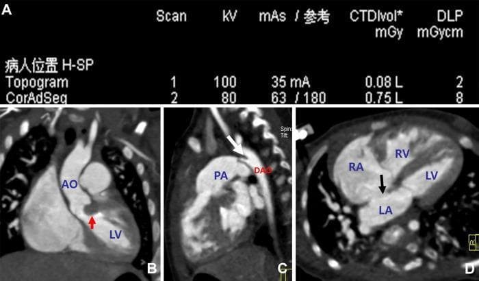 This diagnostic visual includes a panel of multi-slice spiral computed tomography (MSCT) images (B-D) and scan parameters (A) from a 4-month-old female patient with congenital heart disease. Panel B presents a multiplanar reconstructed (MPR) oblique view of the left ventricle (LV) and aorta (AO), where a red arrow highlights a focal protrusion of the ventricular septum into the left ventricular outflow tract (LVOT), consistent with subvalvular aortic stenosis. Panel C is a sagittal MPR view showing the pulmonary artery (PA) and descending aorta (DAO); a white arrow indicates a tubular connection at the aortic isthmus, diagnostic of a patent ductus arteriosus (PDA). Panel D displays an axial slice through the four-chamber view of the heart (RA, RV, LA, LV), where a black arrow identifies a defect in the atrial septum, representing an atrial septal defect (ASD). This image is an educational resource for pediatric cardiology and radiology, demonstrating the use of low-dose MSCT in evaluating complex congenital cardiac anomalies.