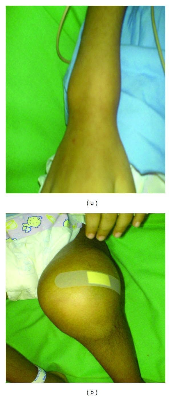This clinical photograph consists of two panels, (a) and (b), illustrating pediatric joint manifestations associated with a nutritional deficiency, likely scurvy (vitamin C deficiency). Panel (a) shows a superior view of the right wrist, demonstrating circumferential, diffuse soft tissue swelling that obscures normal anatomical bony landmarks of the distal radius and ulna. Panel (b) shows the left knee of a child, revealing significant, tense articular swelling and joint effusion that creates a bulbous, rounded appearance of the knee joint. A small adhesive bandage is present on the anterior surface of the knee. In both images, the overlying skin remains intact without obvious discoloration, erythema, or ulceration. These findings are clinically relevant as they represent musculoskeletal manifestations of scurvy, where subperiosteal hemorrhage and metaphyseal fragility lead to painful joint swelling and pseudoparalysis in pediatric patients.