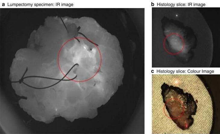 A clinical diagnostic image panel showing ex-vivo breast lumpectomy specimens during surgical pathology processing. Panel (a) presents a whole lumpectomy specimen viewed via infrared (IR) imaging; the tissue appears as a multi-lobulated, hyper-reflective mass against a dark background, with surgical orientation sutures visible and a red dotted circle demarcating the tumor location found 1 mm deep to the surface. Panels (b) and (c) compare an transverse histology slice of the tissue. Image (b) shows the slice in IR, highlighting differences in tissue reflectivity, while image (c) is a standard color photograph showing the specimen's heterogeneous texture and dark peripheral margins on a textured background. In both (b) and (c), a red dotted circle identifies the tumor focus within the medial-to-lateral orientation of the slice. The images illustrate the application of infrared imaging in surgical oncology and pathology for tumor localization and margin assessment.