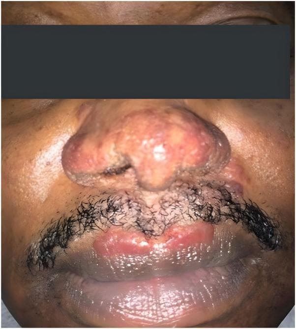 This clinical photograph displays a front-on view of the mid-face of a 56-year-old male, highlighting prominent dermatological manifestations of cutaneous sarcoidosis, specifically lupus pernio. The nasal region is significantly involved, showing diffuse, pinkish-red to violaceous infiltration with multiple confluent, shiny nodules that distort the nasal contour. The surface appears irregular and indurated. In the perioral area, reddish-brown, shiny, well-demarcated plaques are visible along the vermilion border of the upper lip and extending into the philtrum and mustache region. The affected skin shows a characteristic waxy or translucent texture. This image serves as a classic educational representation of chronic sarcoidosis, where granulomatous infiltration typically affects the 'central face' (nose, lips, and cheeks). Clinical significance lies in recognizing these specific morphologies, which are often refractory to treatment and can be associated with underlying systemic sarcoidosis or upper respiratory tract involvement.