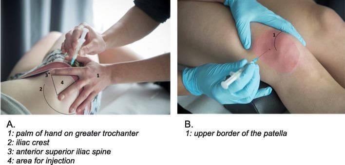 This composite educational image illustrates two clinical procedural techniques: ventrogluteal intramuscular (IM) injection and superolateral intra-articular (IA) knee injection.
Panel A displays the anatomical landmarks for a ventrogluteal injection. It shows a hand positioned with the palm on the greater trochanter (1) and fingers spread toward the iliac crest (2) and the anterior superior iliac spine (3). The triangular area between the index and middle fingers (4) marks the safe injection site, chosen to avoid the sciatic nerve and penetrate less subcutaneous fat.
Panel B demonstrates the superolateral approach for an intra-articular knee injection. The practitioner, wearing sterile blue gloves, locates the injection site approximately 1 cm lateral to the lateral border of the patella and just below its upper border (1). A syringe is shown inserted at this site, targeting the joint space.
These clinical photographs serve as a procedural guide for medical students and practitioners, emphasizing the use of palpable bony landmarks to ensure accurate needle placement and patient safety during corticosteroid or analgesic administration.
