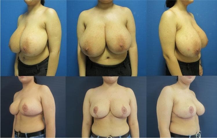 This clinical photograph comparison chart demonstrates the results of a Double-Unit Superomedio-Central (DUS) Pedicled Inverted-T Reduction Mammaplasty in a 20-year-old patient with symptomatic gigantomastia and Regnault Grade II ptosis. The top row shows preoperative views (frontal and bilateral oblique) illustrating significant macromastia, elongated sternal notch-to-nipple-areolar complex (SN-NAC) distances of 34-36 cm, and prominent lower pole fullness. The bottom row presents the status 12 months postoperatively from the same angles. The procedure achieved a substantial reduction in volume (1602g right, 1150g left) and corrected the ptosis by repositioning the NAC to a more anatomical level above the inframammary fold. Key visual changes include improved upper pole projection, a more conical and stable breast shape, and healed surgical scars in the characteristic inverted-T (anchor) pattern. This comparison highlights the efficacy of the DUS pedicle technique in preserving NAC vascularity while managing significant resection weights in young patients.