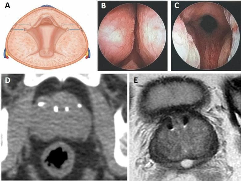 Multi-panel educational figure demonstrating the Prostatic Urethral Lift (PUL) procedure using the UroLift system for Benign Prostatic Hyperplasia (BPH) treatment. Panel A is a cross-sectional anatomical diagram illustrating four implants placed transversely to compress lateral prostatic lobes and widen the urethral lumen. Panels B and C are comparative cystoscopy photographs: B shows the baseline prostatic urethra obstructed by lateral lobes, while C displays the post-procedure 'continuous channel' and reduced obstruction. Panel D is a computed tomography (CT) scan in the axial plane showing the radiopaque UroLift implants as small, hyperdense (bright) points within the prostate. Panel E is a corresponding T2-weighted MRI scan showing the implants as signal voids with small surrounding artifacts, demonstrating their impact on prostatic urethral morphology. This figure provides a multimodal comparison of surgical intervention, illustrating how mechanical compression of glandular tissue relieves urinary obstruction.