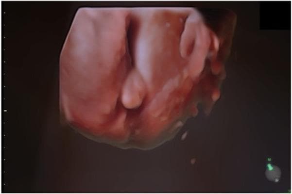 This diagnostic image is a 3D surface rendering ultrasound of male fetal external genitalia at 20 weeks of gestation. The rendering provides a detailed view of the perineal region, showing the developing penis and scrotum. The penis is visible as an elongated, midline protuberance with a smooth surface contour. Posterior to the phallus, the scrotal sac appears as a distinct, bulbous structure. The image demonstrates the spatial relationship between the fetal limbs and the genital area, highlighting the 'snail sign' or 'turtle sign' characteristic of male fetal sex identification in the second trimester. Clinical significance includes the assessment of sexual development and screening for potential anatomical variations, such as hypospadias or ambiguous genitalia, particularly in cases where prenatal genetic screening suggests mosaicism or sex development disorders.