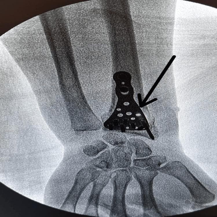 This diagnostic fluoroscopic X-ray image demonstrates a post-operative view of the distal forearm and wrist, specifically illustrating open reduction and internal fixation (ORIF) for a distal radius fracture. Centered on the distal radius is an anatomically shaped, metallic volar-locked distal radius plate. The implant features a characteristic triangular distal head that conforms to the radial metaphysis and an elongated proximal shaft. The distal portion of the plate contains multiple circular radiopaque densities representing locking screws or screw holes, arranged in a configuration designed to stabilize subchondral bone and articular fragments. The proximal shaft contains several elongated screw holes for diaphyseal fixation. A black arrow points specifically to the volar plate at the fracture site. The carpal bones and distal radioulnar joint are partially visible, demonstrating the plate's proximity to the radiocarpal joint surface. This image serves as a clinical example of orthopedic osteosynthesis in the management of high-energy wrist trauma.