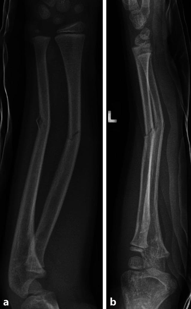This diagnostic image consists of two X-ray radiographs (a.p. and lateral views) showing the left forearm of a pediatric patient. The images demonstrate an acute greenstick fracture of the mid-diaphyseal shafts of both the radius and ulna. In the a.p. view (a), an incomplete fracture line is visible involving the tension side of the cortex with characteristic plastic deformation and bowing of the opposite (intact) cortex. The lateral view (b) highlights the apex-volar angulation of the fracture segments. Visible open growth plates (physes) at the distal radius, distal ulna, and elbow confirm the pediatric nature of the patient. There is no evidence of complete cortical disruption or significant displacement (apposition is maintained), which is typical of greenstick fractures in children where the thick periosteum remains partially intact. This content is used to teach diagnostic hallmarks of pediatric long bone injuries and the clinical importance of the intact opposite cortex in fracture stability.