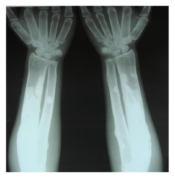 This diagnostic image is an anteroposterior (AP) radiograph of both forearms and hands, illustrating hallmark signs of generalized osteosclerosis, consistent with a metabolic or genetic bone disorder such as osteopetrosis. The imaging shows a marked increase in radiodensity (sclerosis) throughout the radius, ulna, and metacarpals bilaterally. There is a notable loss of the normal corticomedullary differentiation, with the marrow spaces appearing obliterated by dense bone. The surfaces of the long bones exhibit a characteristic smoothening. The metacarpals display an atypical cylindrical morphology, losing their usual mid-shaft tapering. These features indicate significant bone modeling and remodeling defects. The clinical significance of these findings lies in the demonstration of pathologic bone thickening, which often leads to skeletal fragility and hematological complications due to marrow space compression. This visual material is suitable for advanced medical education in radiology and orthopedics, specifically for teaching bone density pathologies.