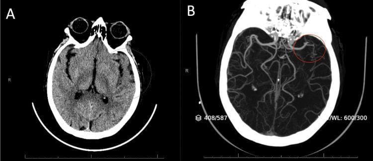 This diagnostic imaging set consists of two axial CT slices of the brain, illustrating the clinical evaluation of an acute ischemic stroke. Panel A is a non-contrast CT (NCCT) scan, which provides a detailed view of the brain parenchyma, demonstrating the differentiation between grey and white matter, the ventricular system, and bony landmarks. It is primarily used in the acute setting to rule out intracranial hemorrhage. Panel B is a CT Angiogram (CTA) maximum intensity projection (MIP) image, which highlights the intracranial vasculature through contrast enhancement. The image reveals a focal vascular abnormality in the left hemisphere. Specifically, a red circle highlights a proximal occlusion or hyperdense embolus located in the M2 segment of the left middle cerebral artery (MCA). This comparison illustrates the transition from ruling out hemorrhage with NCCT to identifying large vessel occlusion (LVO) with CTA. These modalities are critical in determining eligibility for reperfusion therapies like tissue plasminogen activator (tPA) or mechanical thrombectomy.