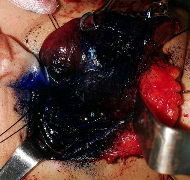 A clinical photograph of an intraoperative surgical field during a thyroidectomy, demonstrating the use of methylene blue spraying for tissue differentiation. The image illustrates the anatomical relationship between the thyroid gland (labeled 'T'), parathyroid gland ('P'), and the recurrent laryngeal nerve ('R'). The thyroid gland and surrounding perithyroidal connective tissues appear heavily stained with dark blue/black dye. In contrast, the parathyroid gland ('P') is visible as a relatively unstained, lighter-colored nodule, facilitating its identification and preservation. The recurrent laryngeal nerve ('R') is located within the deeply stained operative bed. Surgical retractors and stay sutures are visible, providing exposure of the neck anatomy. This image serves as an educational example of vital staining techniques used in endocrine surgery to distinguish parathyroid tissue from thyroid and adipose tissues, minimizing the risk of accidental excision or nerve injury.