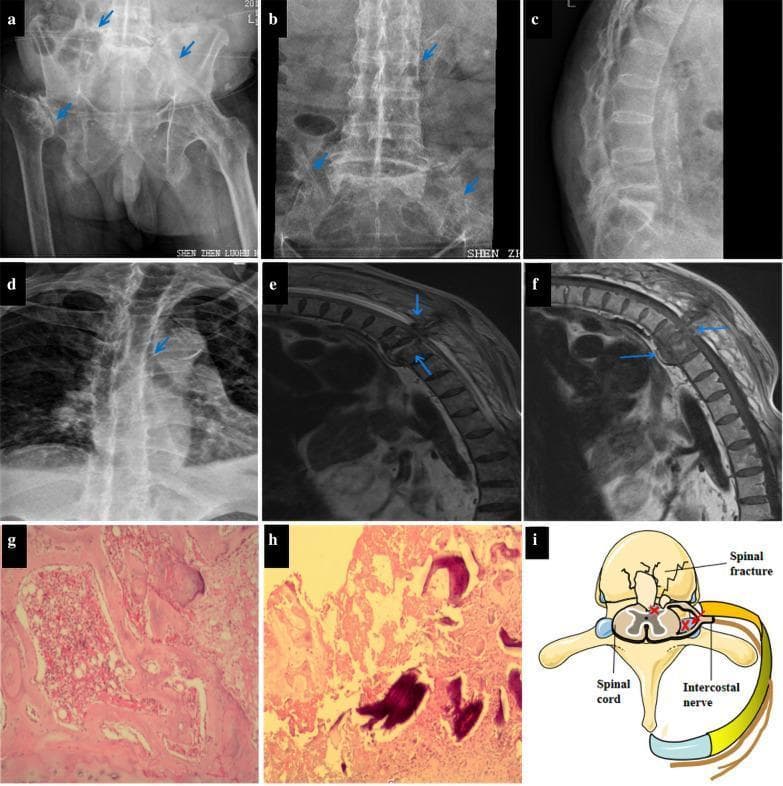 This composite figure presents clinical imaging and pathology related to advanced ankylosing spondylitis (AS). (a-d) X-ray radiographs demonstrate classic musculoskeletal manifestations: bilateral sacroiliitis with joint space narrowing and articular sclerosis, a 'bamboo spine' appearance due to extensive syndesmophyte formation, and thoracic kyphosis. Osteonecrosis of the right femoral head is also visible. (e-f) T2-weighted sagittal MRIs of the thoracolumbar spine reveal destruction at the T9-10 level with disc denaturation, abnormal high signal intensity indicating hemorrhage or edema, and suspected interspinous ligament rupture. (g-h) H&E-stained histopathology (40x) shows necrotic bone fragments, granulation tissue, and fibrous connective tissue with inflammatory infiltration, ruling out malignancy or tuberculosis. (i) A schematic diagram illustrates the pathophysiology of intercostal neuralgia, depicting how a thoracic vertebral fracture can cause mechanical compression of the spinal cord and spinal nerve roots. This collection serves as an educational resource for recognizing the late-stage radiological features of AS and its potential neurological complications.