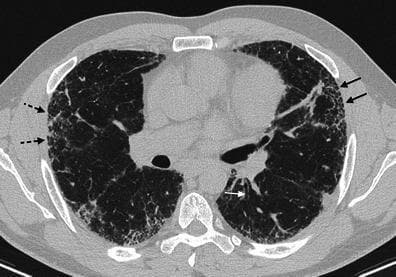 This axial High-Resolution Computed Tomography (HRCT) scan of the thorax demonstrates characteristic findings of a Usual Interstitial Pneumonia (UIP) pattern. The image shows a predominantly subpleural and peripheral distribution of lung abnormalities in both hemispheres. Key diagnostic features include honeycombing, represented by clusters of subpleural cystic airspaces (indicated by black solid arrows), and a fine reticular pattern (indicated by black dotted arrows) consisting of intersecting linear opacities. Additionally, there is evidence of architectural distortion and traction bronchiectasis (indicated by a white arrow), characterized by the irregular dilatation of small bronchi within the areas of fibrosis. These findings are hallmarks of idiopathic pulmonary fibrosis (IPF) and are critical for differentiating UIP from other interstitial lung diseases like Non-Specific Interstitial Pneumonia (NSIP). The image serves as an educational reference for identifying progressive fibrosing interstitial lung disease through imaging markers such as basal predominance, reticulation, and subpleural honeycombing.