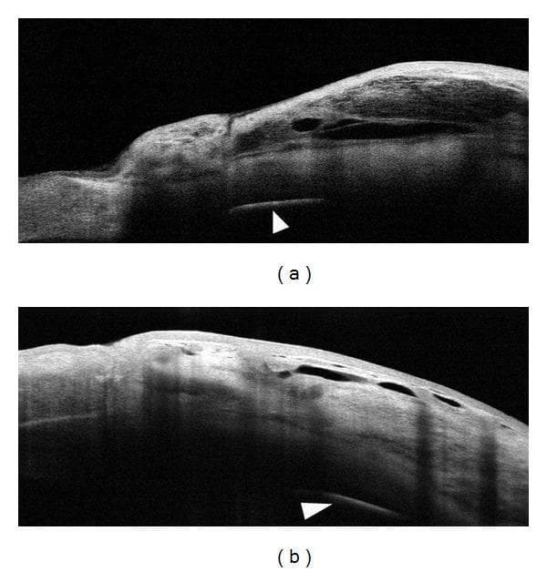 This Comparison Chart features two Anterior Segment Optical Coherence Tomography (AS-OCT) cross-sectional scans (labeled a and b) illustrating filtering bleb morphology following glaucoma surgery. The diagnostic images demonstrate the subconjunctival space and scleral layers three months post-trabeculectomy. Image (a) depicts a filtering bleb where a biodegradable collagen matrix (Ologen) was implanted, showing a slightly thicker bleb wall compared to image (b), which represents a standard trabeculectomy without an implant. Both scans reveal characteristic optically empty cystic spaces within the bleb wall, representing aqueous humor drainage pathways. White arrowheads in both images point to the scleral tissue and the interface between the conjunctival-episcleral layer and the deeper sclera, exhibiting relatively homogeneous reflectivity and similar tissue density across both cases. This clinical imaging is essential for ophthalmology students and clinicians to evaluate bleb functionality, wall thickness, and the presence of internal fluid-filled cavities, which are key indicators of surgical success in intraocular pressure management.