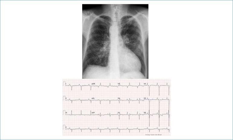 This composite educational image includes a posteroanterior (PA) chest radiograph and a 12-lead electrocardiogram (ECG) demonstrating signs of congenital heart disease and hemodynamic stress. The chest X-ray reveals a moderately enlarged cardiac silhouette with an elongated, rounded apex and an excavated middle arch, suggesting ventricular dominance. A notable anatomical variation is the right-sided aortic arch. The pulmonary vasculature appears prominent, particularly in the hila and lower lung fields, which may indicate systemic-pulmonary collateral circulation. The accompanying ECG shows a sinus rhythm with markers of right-sided heart strain and cavity overload. Key findings include peaked P waves (P-pulmonale) in leads I, II, and left precordial leads, and a significant right-axis deviation of the QRS complex (+180º) with deep S waves from V3 through V6. T-wave inversions in the precordial leads further support right ventricular strain. This combination of findings is characteristic of complex cyanotic congenital heart disease, such as Tetralogy of Fallot or pulmonary atresia with a right-sided aortic arch.