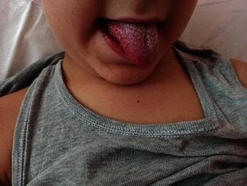 This clinical photograph displays a classic presentation of 'strawberry tongue' in a pediatric patient. The tongue is protruded, showing significant erythema and hypertrophy of the fungiform papillae, which appear as prominent red bumps against a background of white or yellowish exudative coating. This characteristic texture and color profile are hallmarks of systemic inflammatory or infectious conditions. The surrounding perioral skin and chin appear unaffected, without visible rashes or lesions in this view. This visual finding is a critical diagnostic sign in pediatric medicine, commonly associated with Kawasaki disease, Scarlet fever (Group A Streptococcus infection), or Toxic Shock Syndrome. In the provided clinical context, this finding accompanied coronary artery dilation and lymphadenopathy, reinforcing its relevance in the diagnosis of Kawasaki disease. The image serves as a high-yield educational resource for identifying mucosal manifestations of multisystem inflammatory disorders.