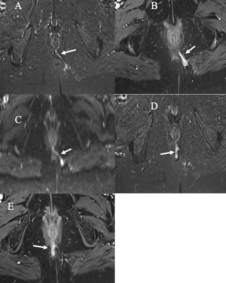 This composite of five axial pelvic MRI scans (labeled A-E) demonstrates a Grade 4 trans-sphincteric perianal fistula with secondary ramification, categorized according to the St. James’s University Hospital classification system. Images A and D utilize STIR (Short Tau Inversion Recovery) sequences, showing the fistula as a hyperintense, fluid-filled tract originating near the 6 o'clock position of the anal canal and crossing the external sphincter. Image B and E are post-contrast fat-suppressed T1-weighted images (T1-WI) showing prominent enhancement of the tract walls, indicating active inflammation. Image C is a Diffusion-Weighted Image (DWI) showing restricted diffusion, which appears as a high-signal (bright) intensity, highlighting the active fistula components. White arrows in all panels identify the primary tract, while panels D and E specifically reveal a secondary ramification branching posteriorly. This diagnostic imaging series is designed for radiology and surgical residents to understand the multi-parametric MRI appearance of complex fistulous disease, including the identification of internal openings and secondary tracts essential for surgical planning.