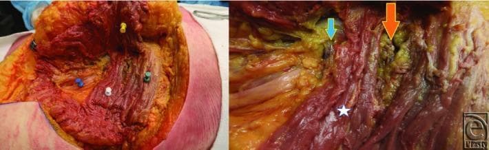 Two clinical photographs show a cadaveric surgical dissection of the human gluteal region, demonstrating the deep anatomical relationships of neurovascular structures. The left panel shows a wide view with the gluteus maximus retracted (yellow push pin). Key structures are marked: the gluteus medius (green push pin), the piriformis muscle (white push pin), and the sciatic nerve (blue push pin) emerging inferior to the piriformis. The superior gemellus muscle is visible deep to these layers. The right panel provides a close-up of the greater sciatic foramen area. A white star marks the piriformis muscle, which serves as a landmark for the gluteal vessels. An orange arrow identifies the superior gluteal vessel emerging above the piriformis, and a small blue arrow identifies the inferior gluteal vessel emerging below it. This dissection illustrates the 'danger zone' for gluteal fat augmentation and highlights the anatomical basis for localizing gluteal neurovascular bundles using muscular landmarks and surface anatomy.