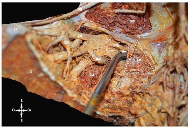 This clinical photograph displays a deep surgical dissection of the human pelvic sidewall (left side) emphasizing the anatomy of Alcock’s (pudendal) canal and the sacral plexus. Key neurovascular structures are visible, including the anterior rami of L4, L5, S1, and S2, which contribute to the lumbosacral trunk (LST) and the sciatic nerve (SN). The superior gluteal artery (SGA) is seen emerging between the LST and S1, while the inferior gluteal artery (IGA) is located caudally. The piriformis muscle (PM) and obturator internus muscle (OIM) provide muscular landmarks. The internal pudendal artery (IPA) is shown tracking toward the entry of Alcock’s canal (AC). A triangular outline highlights the coccygeus muscle (CM) relative to the ischial spine (IS). Medial landmarks include the sacrum (S), sacral promontory (PR), and sacral spine (SP). This educational material demonstrates the complex spatial relationships necessary for surgical navigation in gynecologic oncology and pelvic floor procedures, specifically identifying the transition of neurovascular bundles from the pelvic cavity into the gluteal and perineal regions.