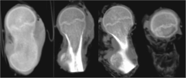 This diagnostic image consists of four CT scan sections of a proximal femoral epiphysis from a 6-year-old child (cadaveric study). The series highlights the morphological and structural characteristics of the growth plate (physis). The epiphysis is visible as a superior region with relatively uniform density, while the metaphysis below exhibits a more trabecular, heterogeneous texture. The growth plate appears as a radiolucent (darker), non-uniform line separating these two regions. In the first image on the left, the physis presents as a thicker, more prominent structure. In the subsequent three sections, it demonstrates a characteristic sinusoidal and irregular form with significant 'ruggedness.' This corrugated interface shows the growth plate interpenetrating both the epiphyseal and metaphyseal bone, which anatomically increases the surface area for stability. The boundary with the metaphysis appears less defined compared to the epiphyseal border, as the physis blends with the underlying trabecular architecture. These images illustrate the complex three-dimensional topology of the pediatric growth plate during mid-childhood development.