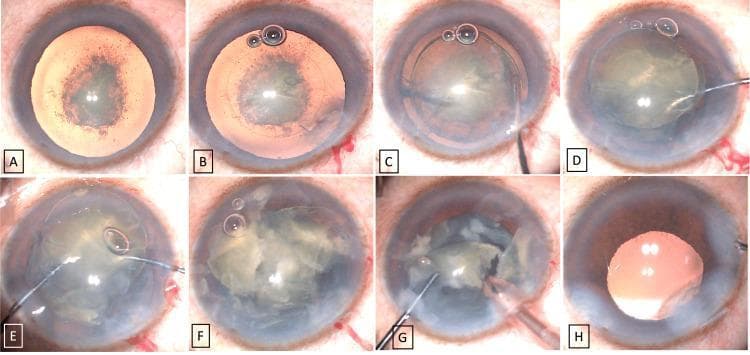 A series of eight clinical photographs (A-H) documenting the surgical stages of phacoemulsification for a posterior polar cataract (PPC). (A) Preoperative view showing a dense posterior subcapsular plaque and grade III nuclear sclerosis. (B) Execution of a 5mm continuous curvilinear capsulorhexis. (C) Successful hydrodelineation, showing the separation of the inner nucleus from the outer epinucleus. (D) Prolapse of the nucleus into the anterior chamber using a Y-rotator instrument. (E) Manual mechanical cracking of the nucleus using the 'two-Y crushing technique' with two rotators. (F) Completion of nuclear fragmentation into multiple segments. (G) Emulsification of the nuclear fragments using a phacoemulsification probe. (H) Postoperative result showing a clear, well-centered single-piece intraocular lens (IOL) implanted within the capsular bag. The series demonstrates an specialized approach to PPC management designed to minimize posterior capsule rupture by prolapsing and mechanical crushing of the nucleus in the anterior segment rather than the posterior chamber.