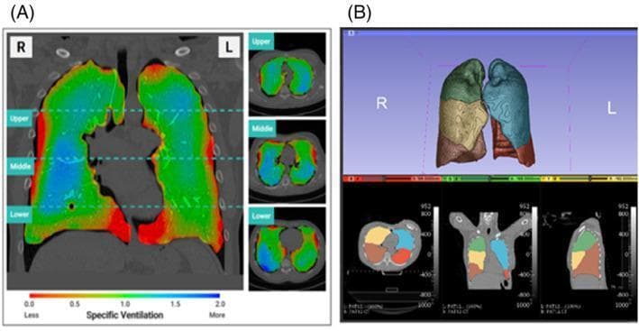 This composite diagnostic image demonstrates functional lung imaging using X-ray Velocimetry (XV) technology. Part A presents a regional lung ventilation map overlaid on CT slices. The mid-coronal view and axial cross-sections (upper, middle, and lower zones) utilize a color-coded heat map to represent specific ventilation: blue indicates hyperventilation, green signifies average ventilation, and red denotes underventilation relative to mean regional volume expansion. The visualization reveals heterogeneous ventilation patterns, with relative underventilation observed at the lung bases and peripheral margins. Part B displays lobe-wise analysis through automated anatomy-based segmentation. It features a 3D volumetric rendering and corresponding multiplanar reformats (axial, coronal, and sagittal) where individual pulmonary lobes are color-coded (e.g., right upper, middle, and lower lobes; left upper and lower lobes) to facilitate regional functional assessment. This modality is used in pulmonology and radiology for quantifying regional lung function and assessing obstructive or restrictive disease distributions.