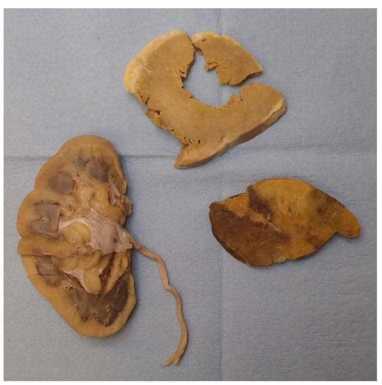 This clinical photograph displays a gross pathological examination of three formalin-fixed tissue specimens from a systemic amyloidosis case, arranged on a blue surgical drape. The specimens include the right kidney (bottom left), the left ventricle of the heart (top center), and a section of the spleen (bottom right). All tissues exhibit a characteristic firm, waxy texture and a diffuse pale-yellow discoloration indicative of extensive amyloid deposition. The kidney specimen, shown in longitudinal section, reveals pale cortical involvement and prominent renal pyramids. The heart specimen shows myocardial thickening with a uniform tan-yellow hue. The spleen specimen demonstrates a 'lardaceous' pattern, characterized by diffuse, map-like pale infiltrates throughout the parenchyma, where amyloid replaces the red pulp. This gross presentation is a hallmark of systemic amyloidosis, where extracellular protein fibrils accumulate, leading to organomegaly and eventual organ failure. This visual is intended for medical education in pathology and internal medicine to illustrate the macroscopic findings of amyloid infiltration across different organ systems.